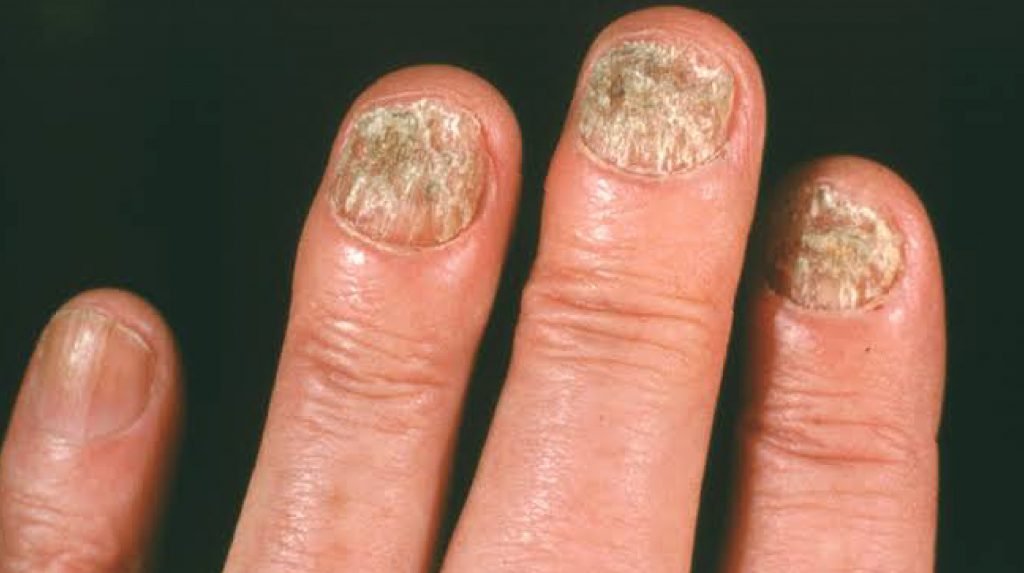 Nail Diseases Types Symptoms Diagnosis Medical Treatment